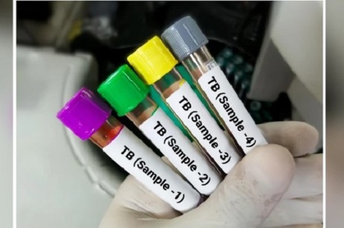 India's TB Fight Outpaces the World: A 21% Decline in Cases Signals a Health Victory